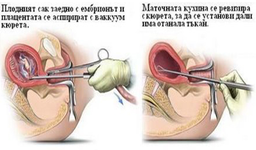 Аспирационен кюретаж