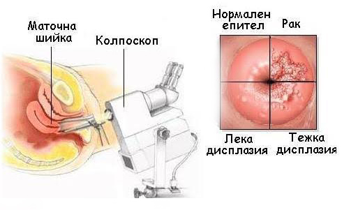 КОЛПОСКОПИЯ