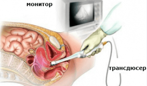Трансвагинална тазова ехография