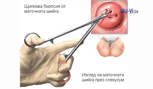 биопсия