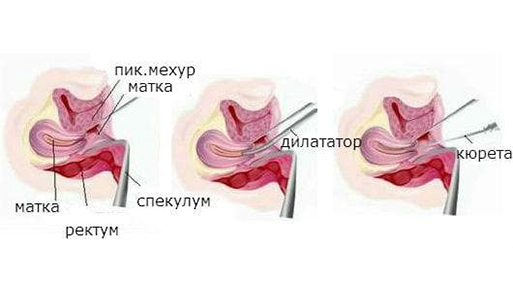 гинекологично абразио пробатория