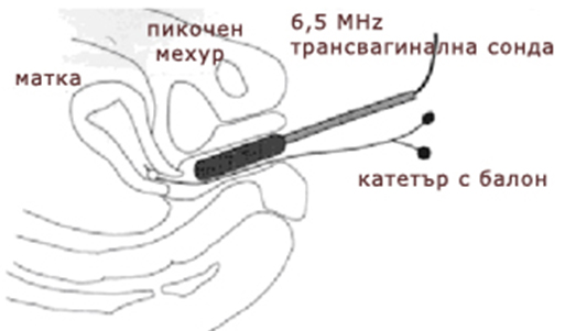 хидротубация